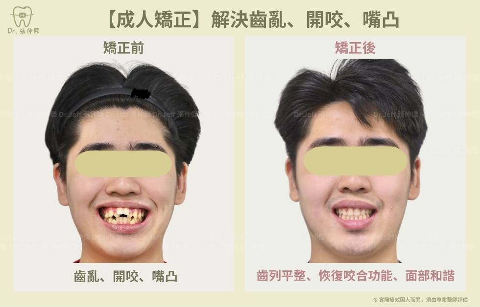 手機 【成人矯正】解決齒亂、開咬、嘴凸
