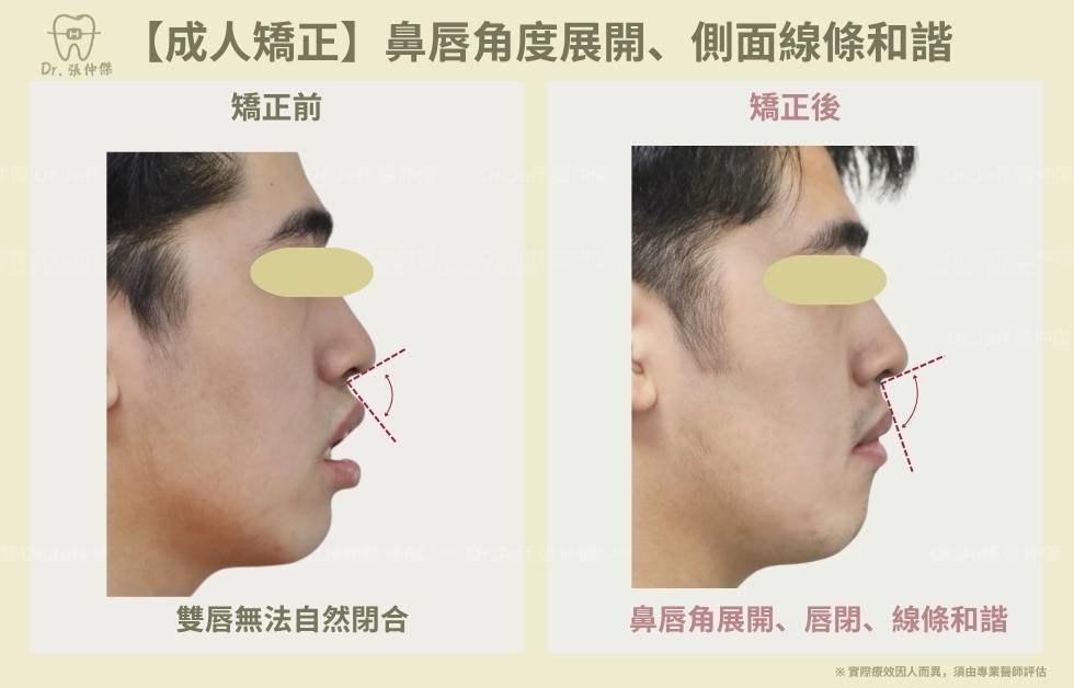 手機 【成人矯正】鼻唇角度展開、側面線條和諧