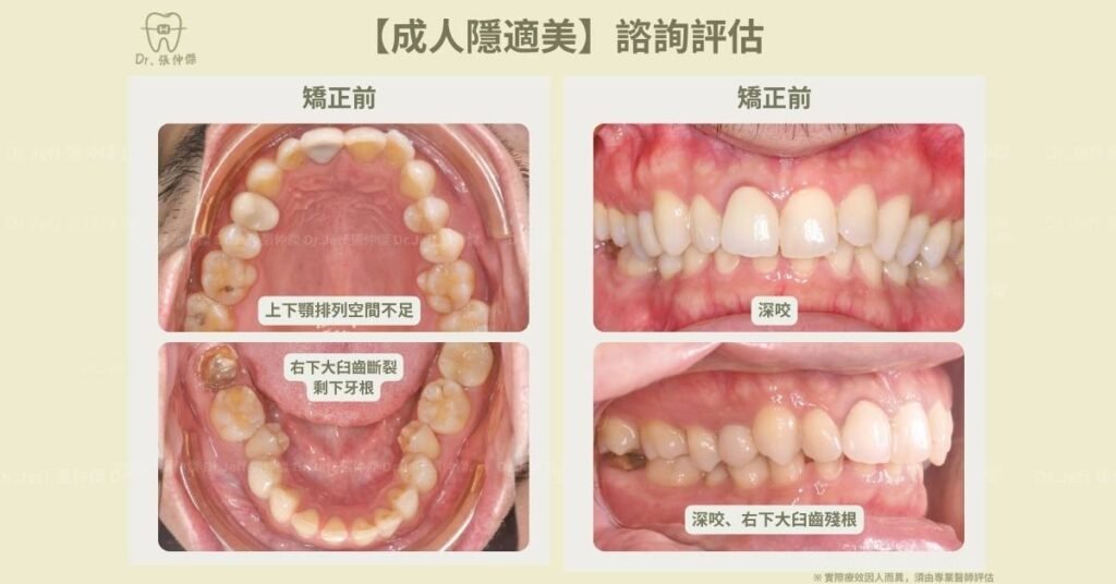 5 3【成人矯正】諮詢評估