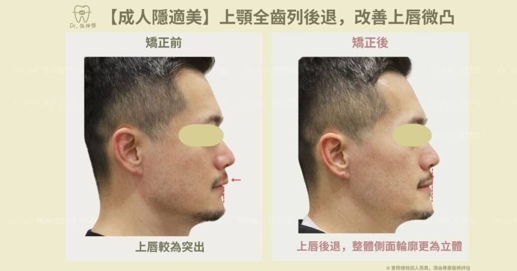 5 4【成人隱適美】上顎全齒列後退，改善上唇微凸
