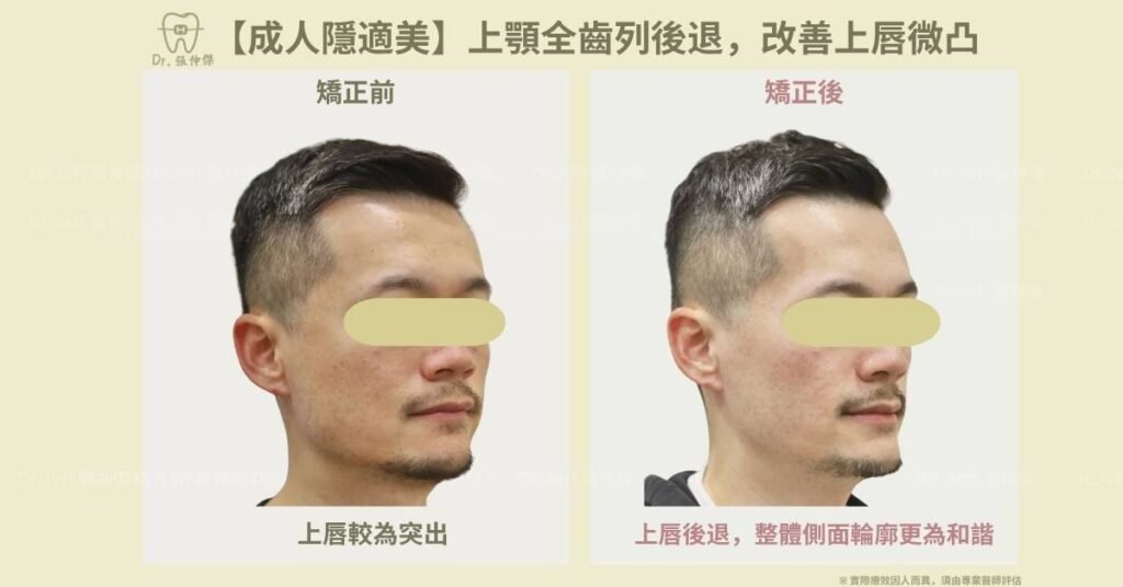 5 5【成人隱適美】上顎全齒列後退，改善上唇微凸