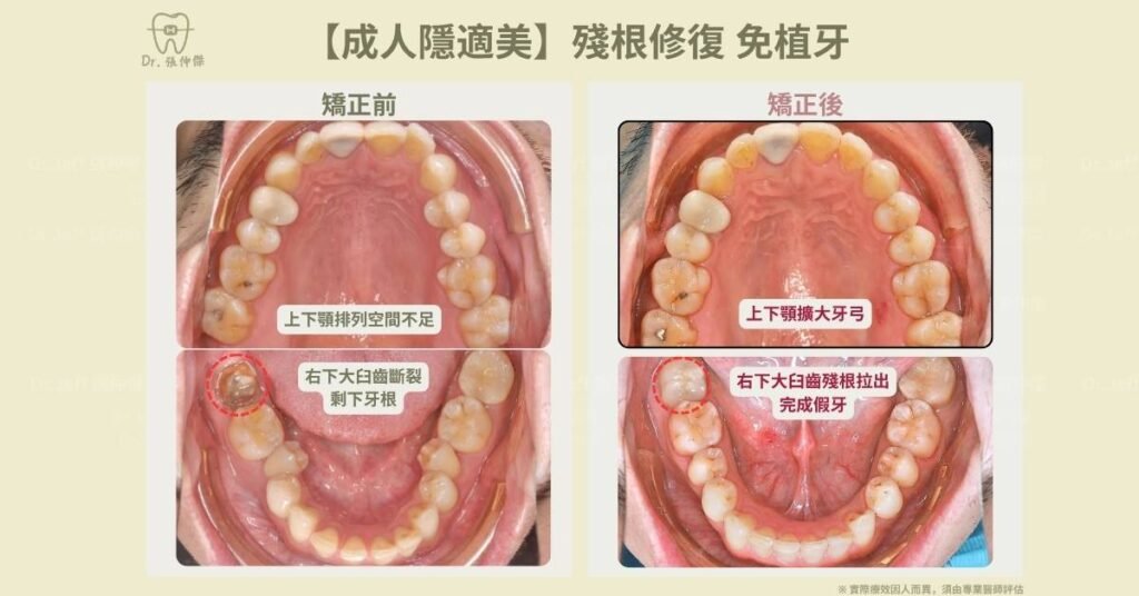 5 6【成人隱適美】殘根修復 免植牙