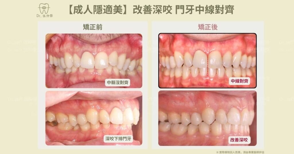5 7 【成人隱適美】改善深咬 門牙中線對齊