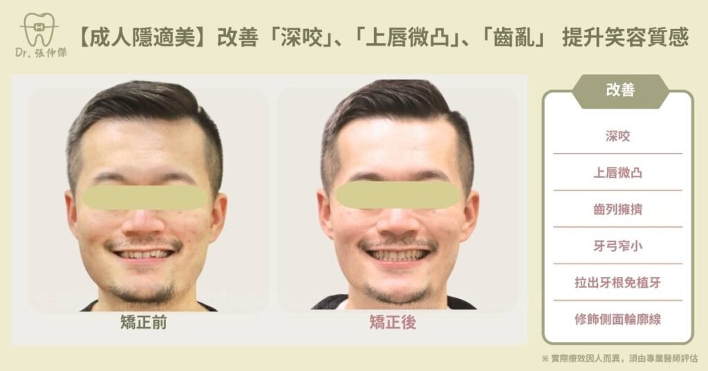 【成人隱適美】改善「深咬」、「上唇微凸」、「齒亂」 提升笑容質感