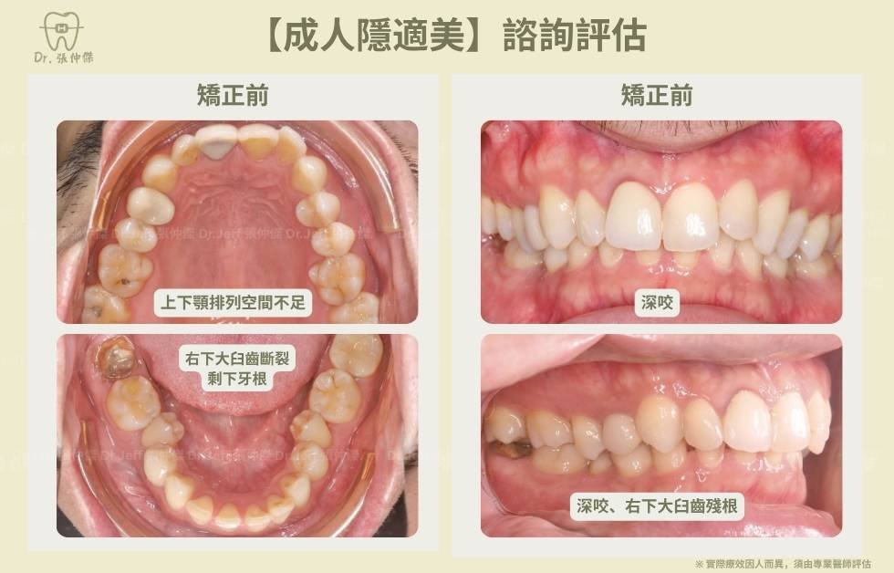 手機 5 3【成人矯正】諮詢評估