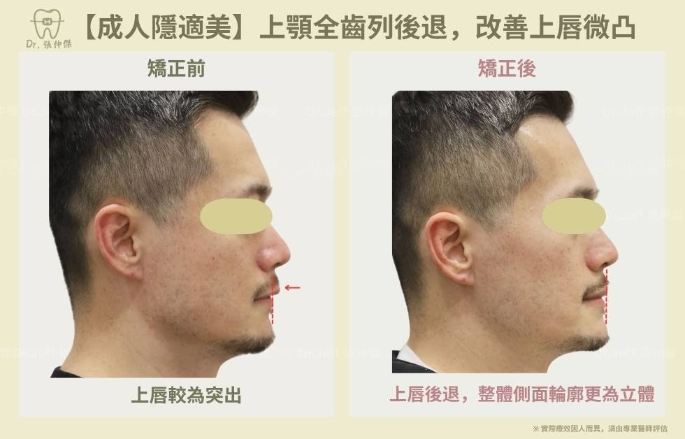 手機 5 4【成人隱適美】上顎全齒列後退，改善上唇微凸