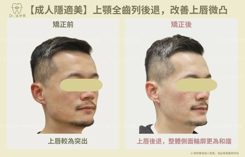 手機 5 5【成人隱適美】上顎全齒列後退，改善上唇微凸