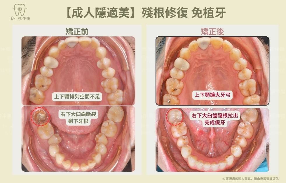 手機 5 6【成人隱適美】殘根修復 免植牙