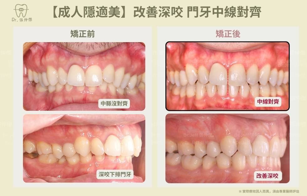 手機 5 7【成人隱適美】改善深咬 門牙中線對齊