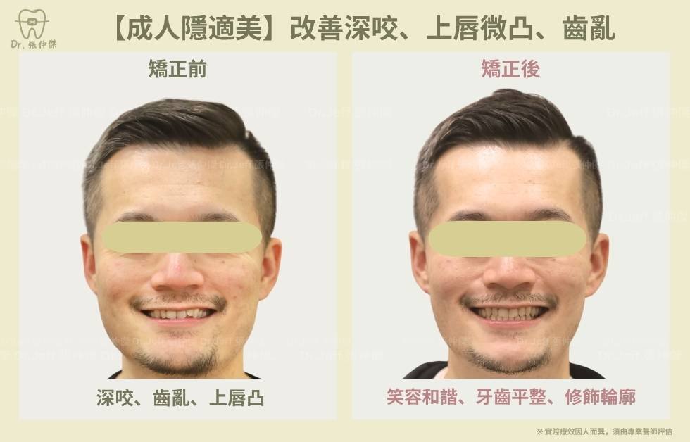 手機 【成人隱適美】改善深咬、上唇微凸、齒亂