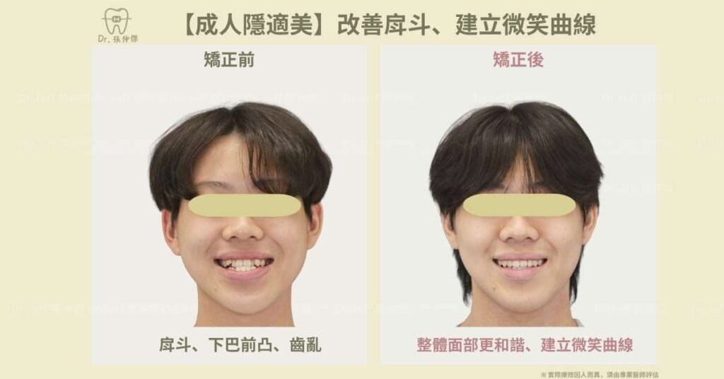 【成人隱適美】非手術改善「戽斗」、「反咬」 隱適美不拔牙 建立微笑曲線 6 4【成人隱適美】改善戽斗、建立微笑曲線