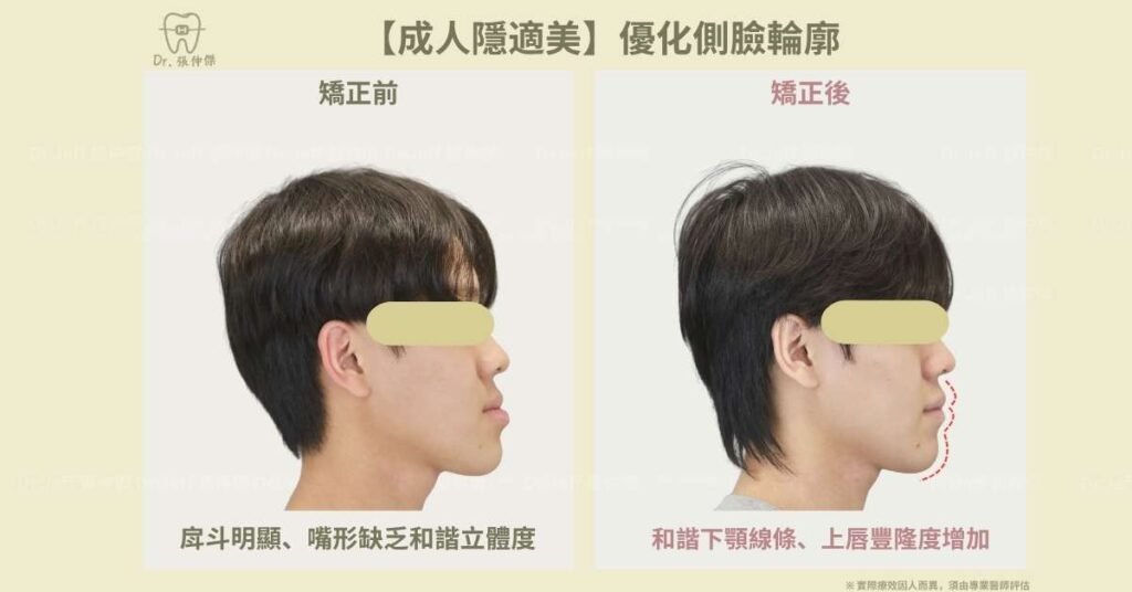 【成人隱適美】非手術改善「戽斗」、「反咬」 隱適美不拔牙 建立微笑曲線 6 5【成人隱適美】優化側臉輪廓