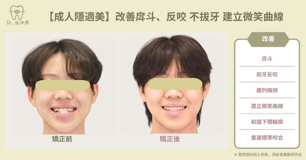 【成人隱適美】非手術改善「戽斗」、「反咬」 隱適美不拔牙 建立微笑曲線