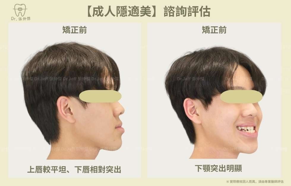 【成人隱適美】非手術改善「戽斗」、「反咬」 隱適美不拔牙 建立微笑曲線 手機 6 2 【成人隱適美】諮詢評估