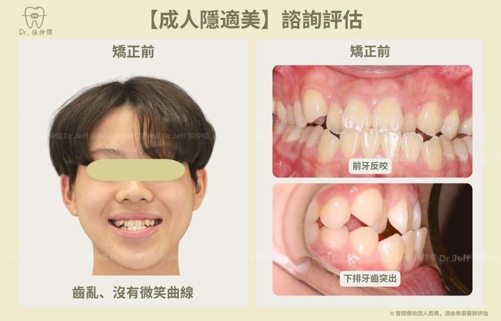 【成人隱適美】非手術改善「戽斗」、「反咬」 隱適美不拔牙 建立微笑曲線 手機 6 3 【成人隱適美】諮詢評估