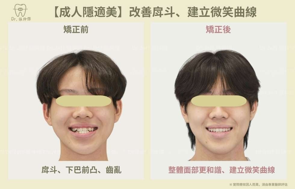 【成人隱適美】非手術改善「戽斗」、「反咬」 隱適美不拔牙 建立微笑曲線 手機 6 4【成人隱適美】改善戽斗、建立微笑曲線