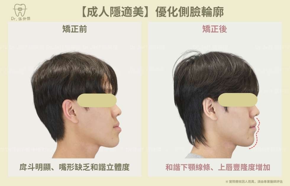 【成人隱適美】非手術改善「戽斗」、「反咬」 隱適美不拔牙 建立微笑曲線 手機 6 5【成人隱適美】優化側臉輪廓