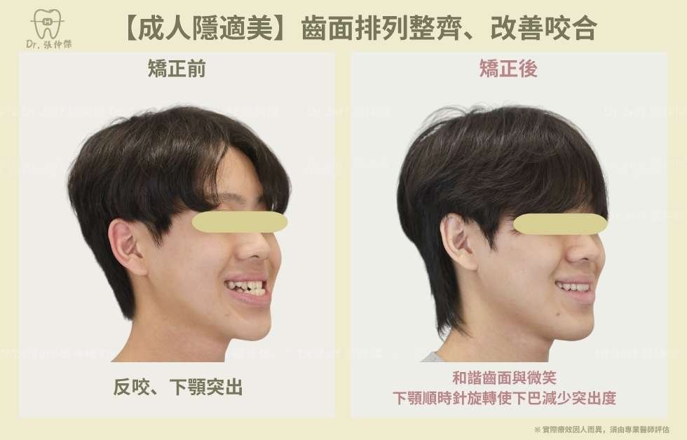 【成人隱適美】非手術改善「戽斗」、「反咬」 隱適美不拔牙 建立微笑曲線 手機 6 6【成人隱適美】齒面排列整齊、改善咬合