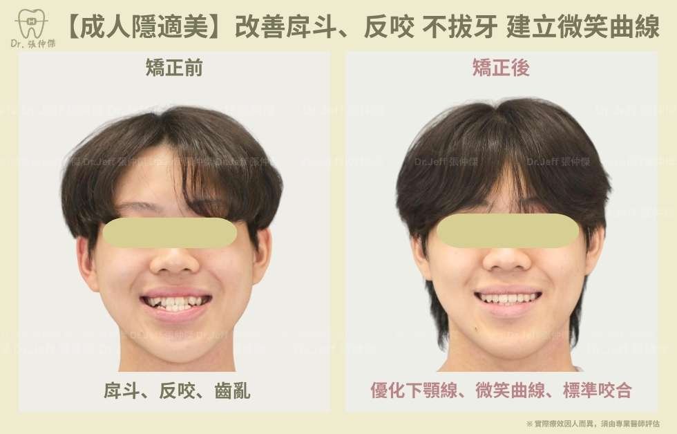 手機 【成人隱適美】改善戽斗、反咬 不拔牙 建立微笑曲線
